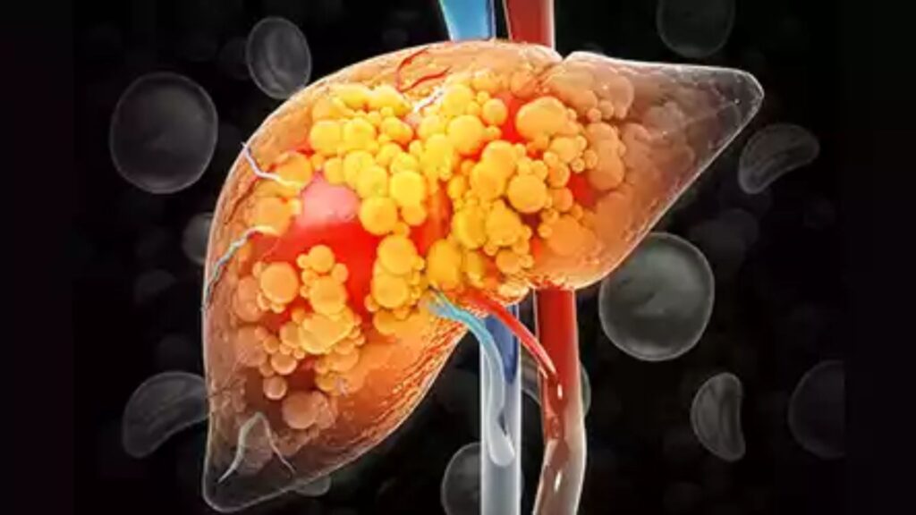 Fatty Liver - Causes, Prevention | Fibronostics